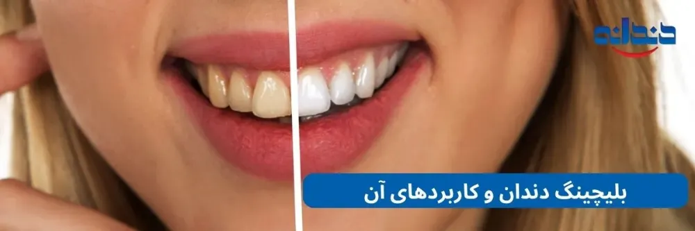 بلیچینگ دندان و کاربردهای آن